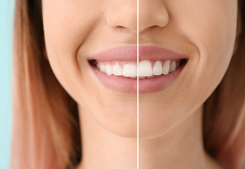 Bild von Zähnen vor einer Gummy-Smile Behandlung