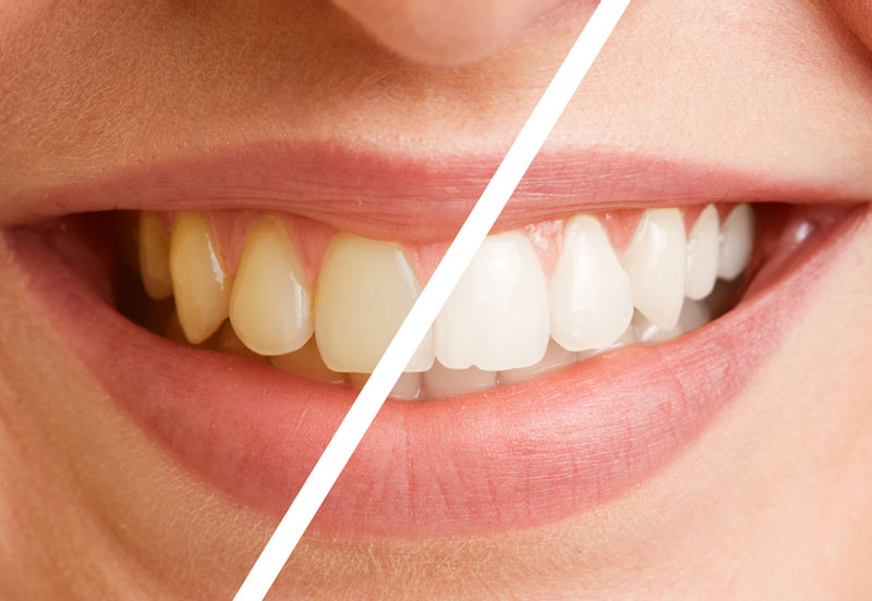 bleaching-berlin-kudamm Ein Lächeln vor- und nach dem Bleaching